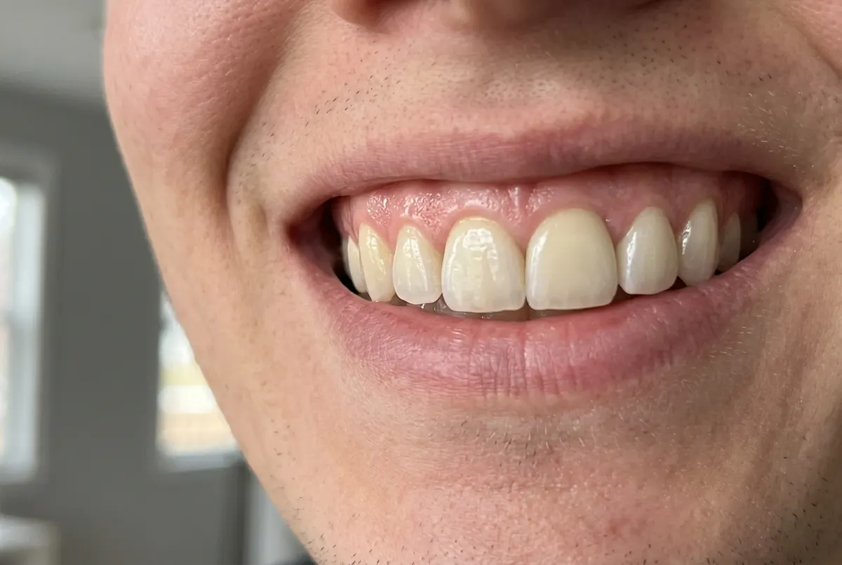 Foam formula works uniformly on crowns, veneers, and natural teeth alike